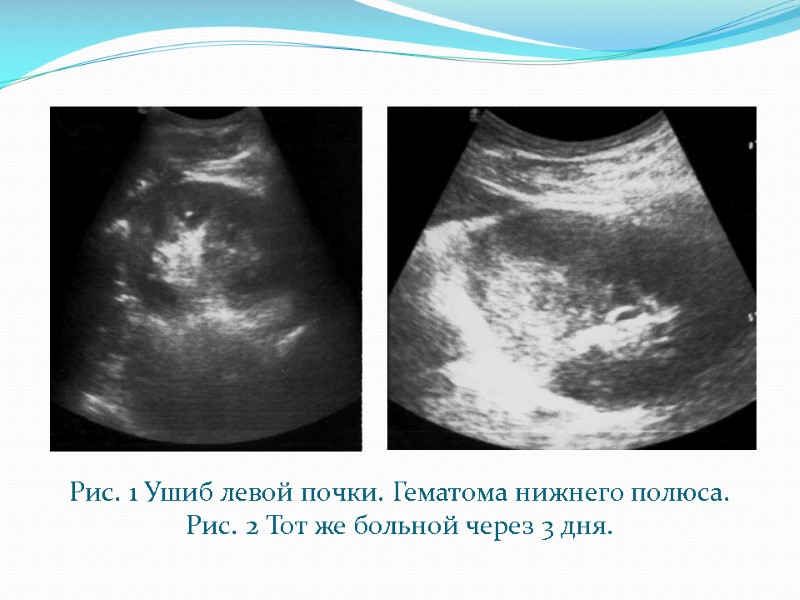 Рис. 1 Ушиб левой почки. Гематома нижнего полюса.  Рис. 2 Тот же больной